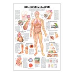 Plakat med Diabetes Mellitus